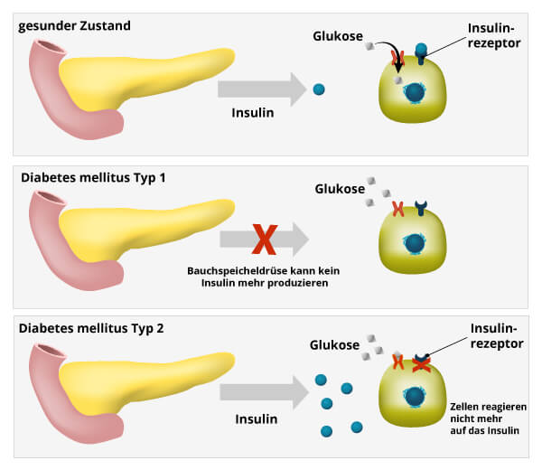 Tabletta diabetes mellitus glibomet